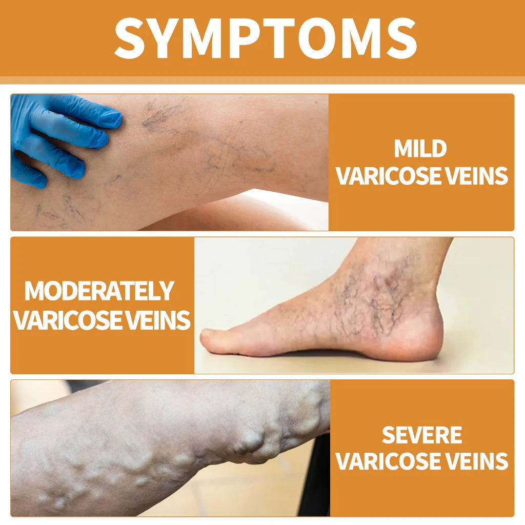 Turmeric Varicose Vein Relief (pack of 3)