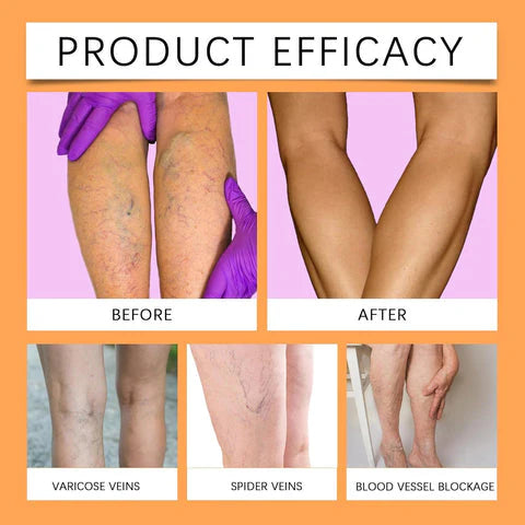 Turmeric Varicose Vein Relief (pack of 3)