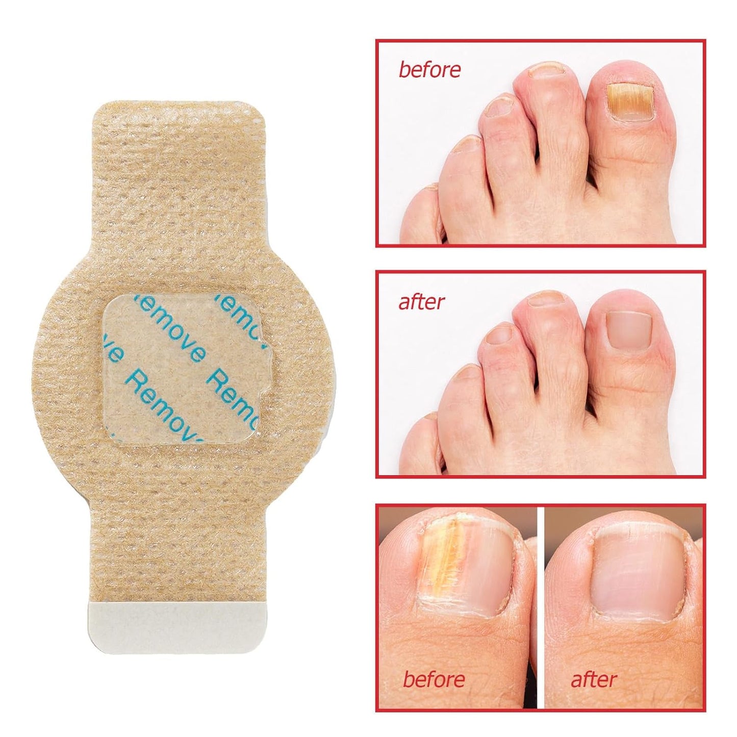 Elaimei™ - Fungal Nail Patches ( Buy 1 Get 1 Free)