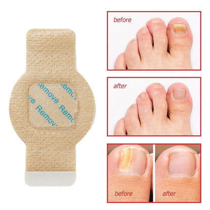Elaimei™ - Fungal Nail Patches ( Buy 1 Get 1 Free)